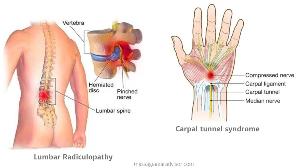 Can Massage for A Pinched Nerve be The Cure for Relief? (HH)